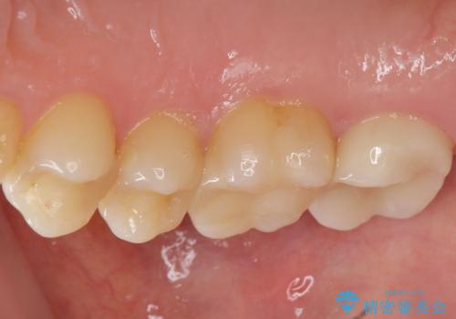 メタルフリー治療　銀歯を全て除去したいの治療後