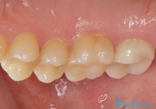 メタルフリー治療 銀歯を全て除去したいの治療後