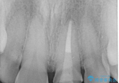 変色した前歯 ジルコニアクラウンでの修復の治療中