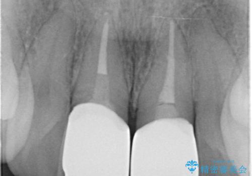 変色した歯を綺麗にしたい 根管治療からジルコニアクラウンでの修復の治療後