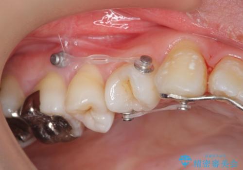 捻れた奥歯 突き出た前歯を治したいの治療前