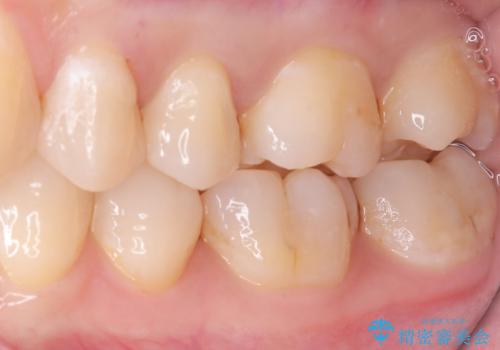 【セラミックインレー】歯が欠けたので治したいの治療後