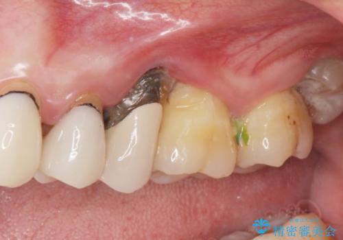 重度歯周病　抜歯後のブリッジ治療の治療前