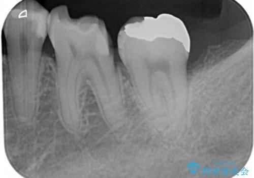 金属の詰め物が取れた オールセラミッククラウンの治療前