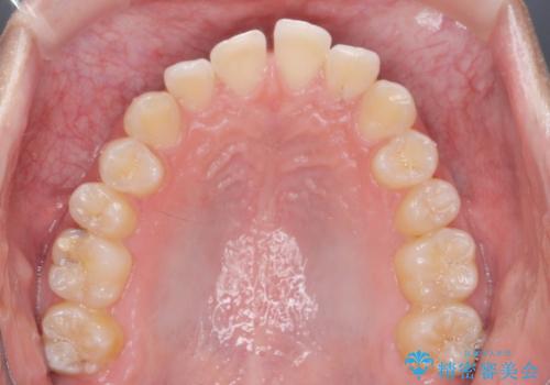 [ インビザライン ]  目立つすきっ歯をマウスピース矯正で改善の治療前