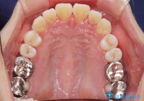 捻れた奥歯 突き出た前歯を治したいの治療後