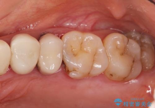 重度歯周病 抜歯後のブリッジ治療の治療中