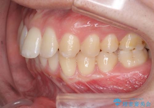 [ インビザライン ]  目立つすきっ歯をマウスピース矯正で改善の治療前