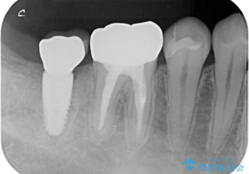歯がないところにインプラントを入れたいの治療後