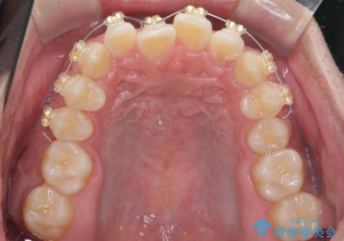 骨格性の受け口の矯正　部分ワイヤーで上の前歯を前に、　マウスピースで下の前歯を後ろに。の治療中