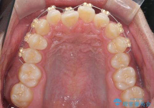 骨格性の受け口の矯正 部分ワイヤーで上の前歯を前に、 マウスピースで下の前歯を後ろに。の治療中