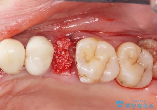 重度歯周病　抜歯後のブリッジ治療の治療中