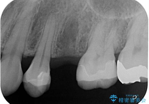 歯が割れてしまった インプラント治療で噛めるように!の治療前