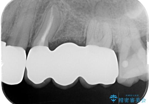 重度歯周病　抜歯後のブリッジ治療