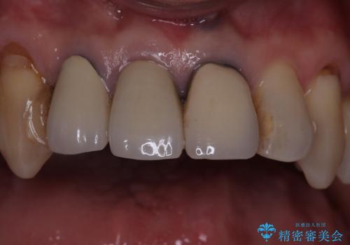 前歯を綺麗にしたいの治療前