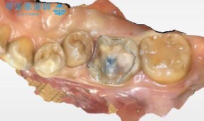 詰め物が外れた 一日でセラミック修復の治療中