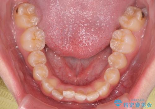 前歯の並び インビザライン 非抜歯で 深いかみ合わせの治療の治療前