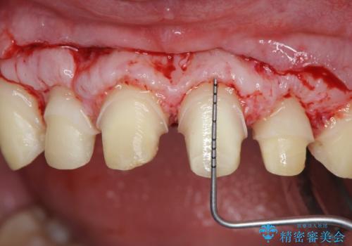 歯周外科を行い、歯ぐきの状態を整えた前歯セラミック治療の治療中