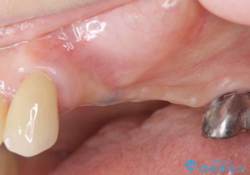 複数の奥歯の欠損 インプラントによる咬合機能回復の治療前