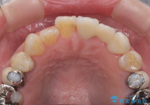 ぐらぐらする前歯 前歯のブリッジ治療の治療後