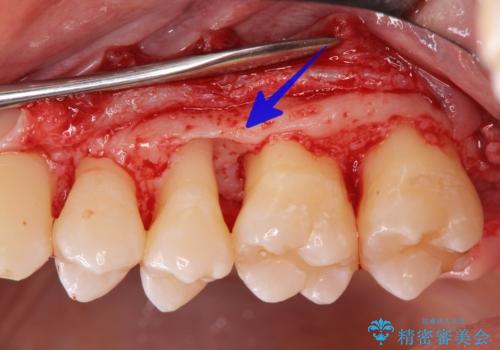[ 歯周病 ]  歯槽骨の再生治療で歯を残す