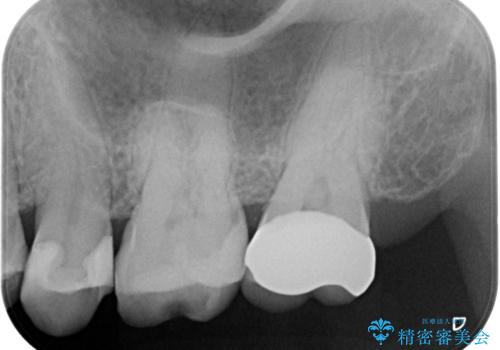 [ メタルフリー ] 金属を外してセラミック治療の治療後