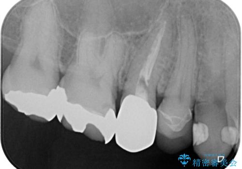 できるだけ歯質を残した1day治療 セラミックインレーの治療後