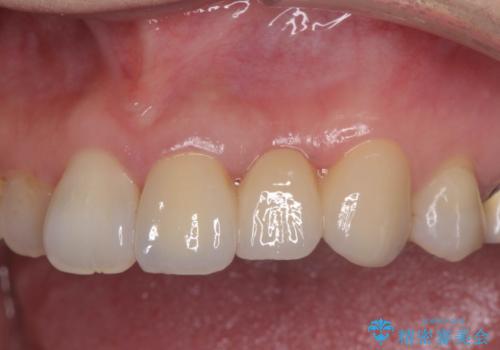 ぐらぐらする前歯 前歯のブリッジ治療の症例 治療後