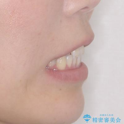 閉じにくい口元をワイヤー抜歯矯正でスッキリ改善の治療前(顔貌)