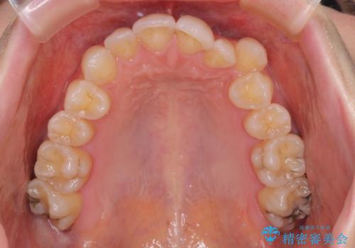 【モニター】顎のゆがみをカムフラージュ ワイヤー装置の抜歯矯正の治療前