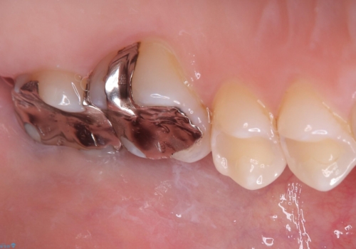 【セラミッククラウン】歯を白くしたいの治療前