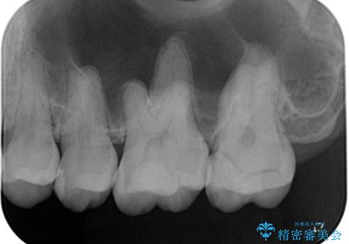 詰め物の下に虫歯があると言われた　オールセラミッククラウンの治療前
