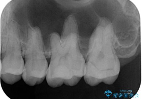 詰め物の下に虫歯があると言われた オールセラミッククラウンの治療前