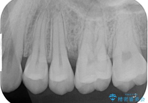 [ 歯周病 ]  歯槽骨の再生治療で歯を残すの症例 治療後