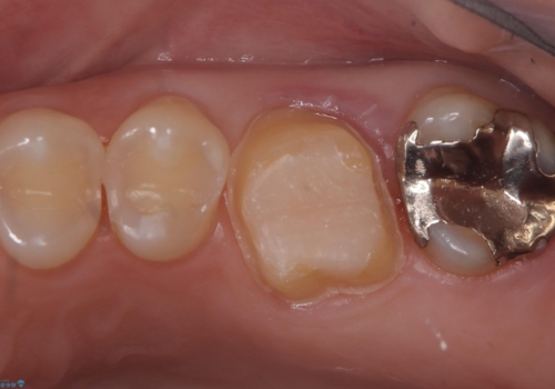 【セラミッククラウン】歯を白くしたいの治療中