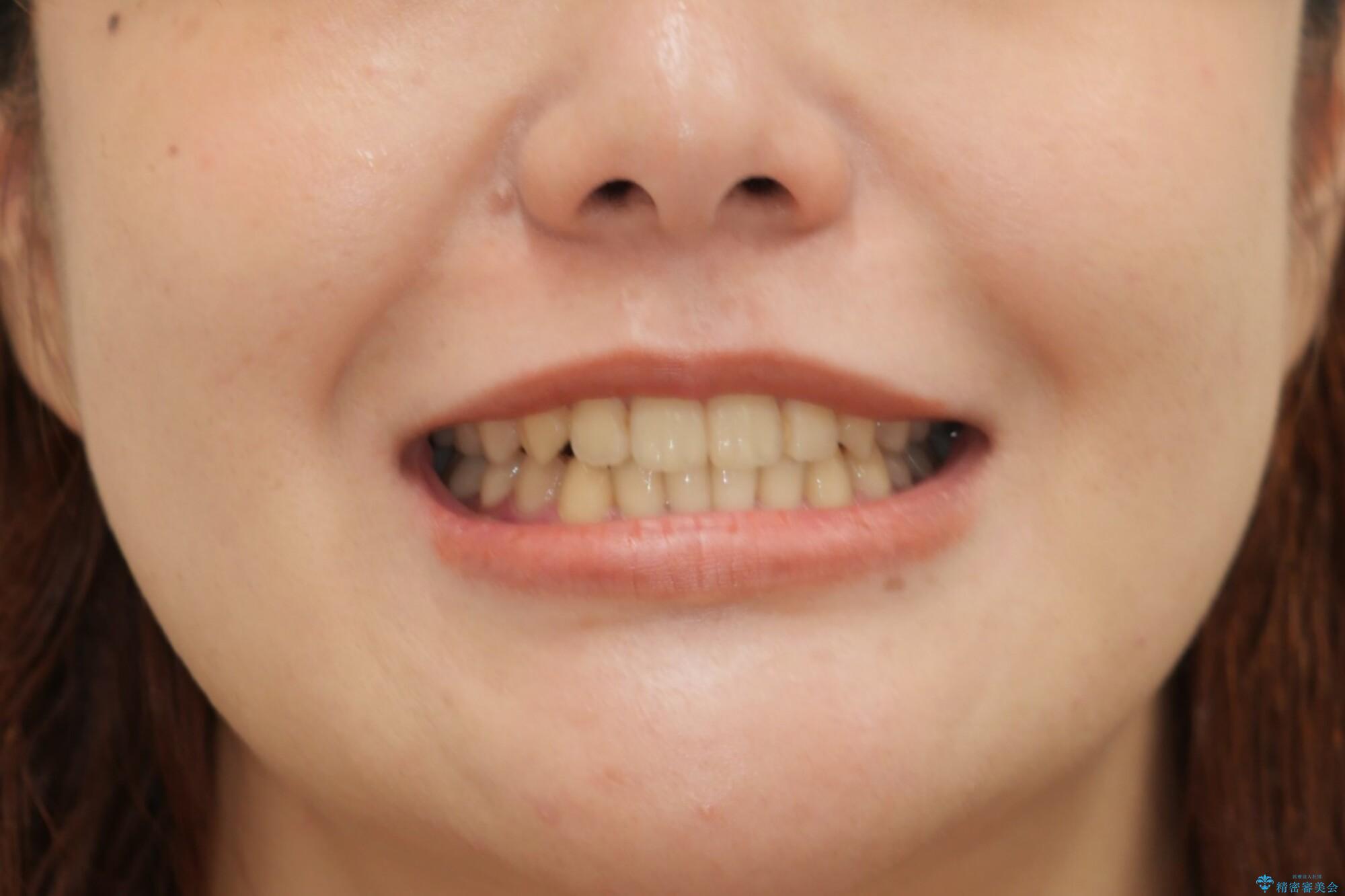 八重歯とクロスバイト:インビザライン治療の治療後(顔貌)