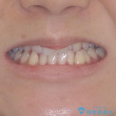 骨格的な問題を側方拡大で解決 ワイヤー矯正治療の治療前(顔貌)