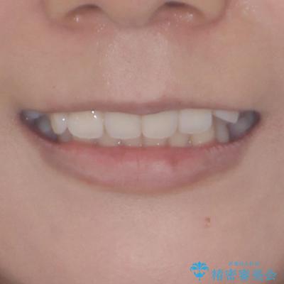 前歯のデコボコを解消 インビザラインの矯正治療の治療前(顔貌)