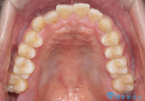【インビザライン】前歯が出ているのを治したい。の治療前