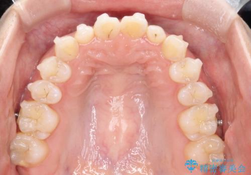 【インビザライン】矮小歯を有する方の矯正治療の治療中