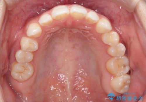 【インビザライン】欠損歯に対する矯正治療の治療前