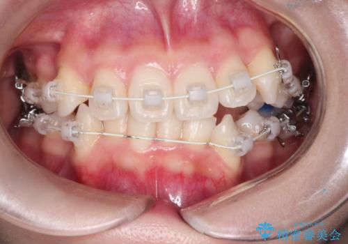 【審美ワイヤー】八重歯を治したい。の治療中