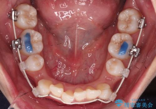 【審美ワイヤー】八重歯を治したい。の治療中