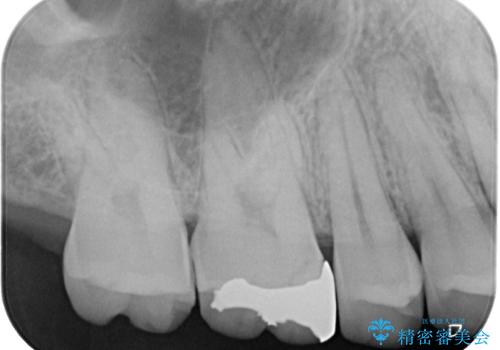 銀歯を白くしたい セラミックインレー修復の治療前