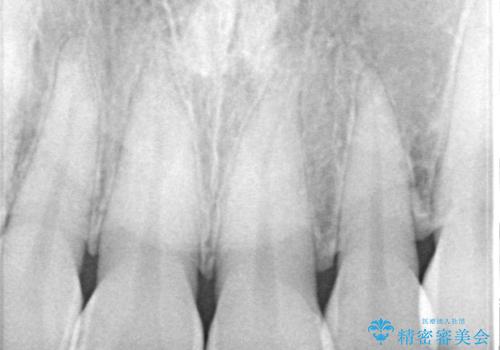 前歯をきれいにしたい　オールセラミッククラウンの治療前