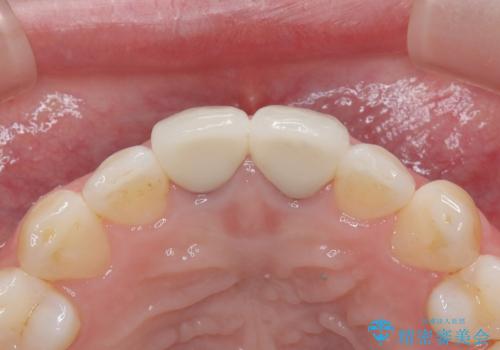 セラミッククラウンで前歯の変色を改善の治療後