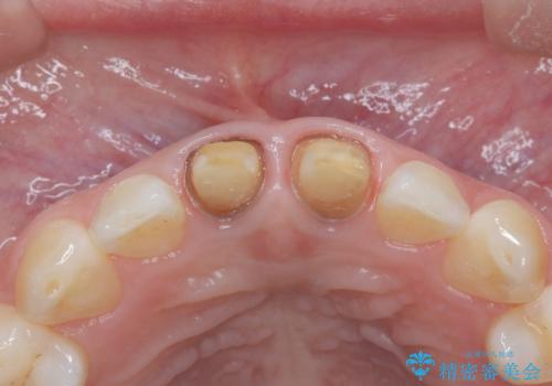 セラミッククラウンで前歯の変色を改善の治療中