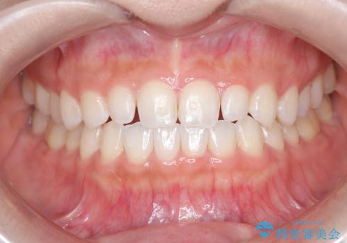 【ダイレクトボンディング】歯を削らずに綺麗にしたい。 の治療前