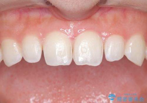 【ダイレクトボンディング】歯を削らずに綺麗にしたい。 の症例 治療前
