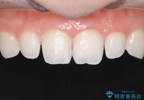 【ダイレクトボンディング】歯を削らずに綺麗にしたい。 の治療前